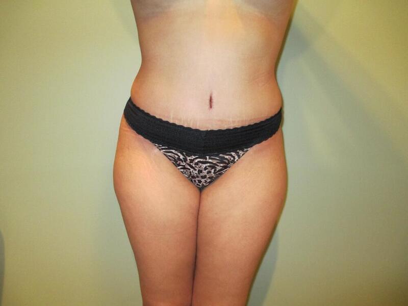 Tummy Tuck Before & After Image