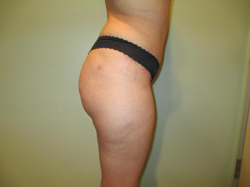 Tummy Tuck Before & After Image