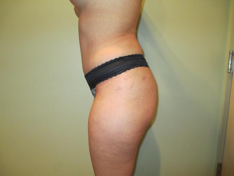 Tummy Tuck Before & After Image