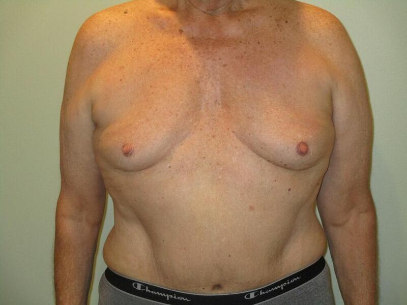 Tummy Tuck Before & After Image