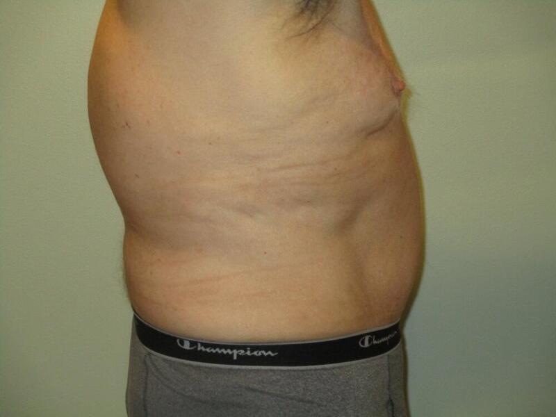 Tummy Tuck Before & After Image