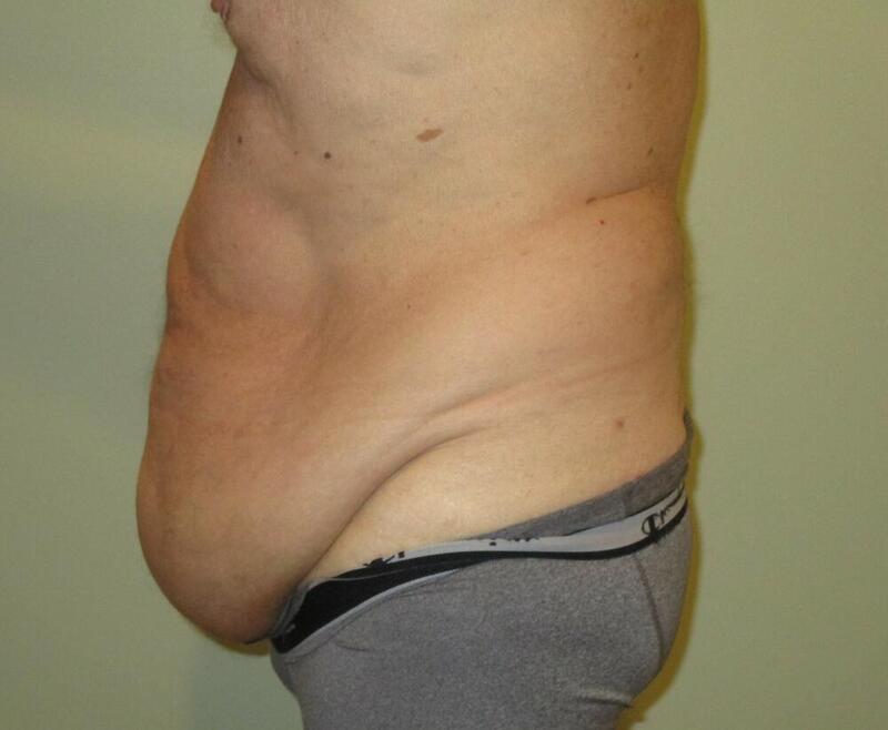 Tummy Tuck Before & After Image