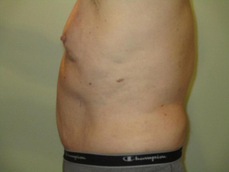 Tummy Tuck Before & After Image