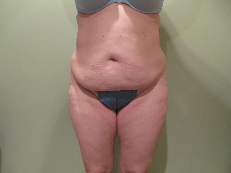 Tummy Tuck Before & After Image