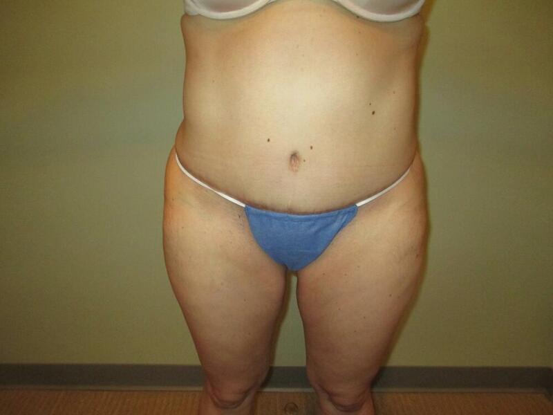 Tummy Tuck Before & After Image