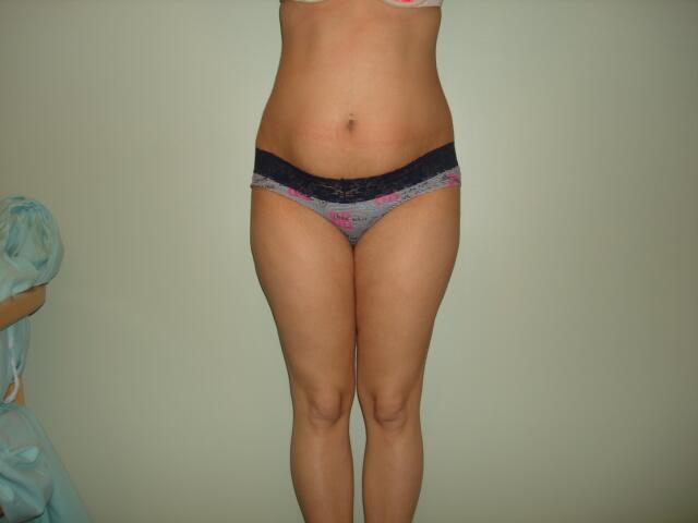 Tummy Tuck Before & After Image