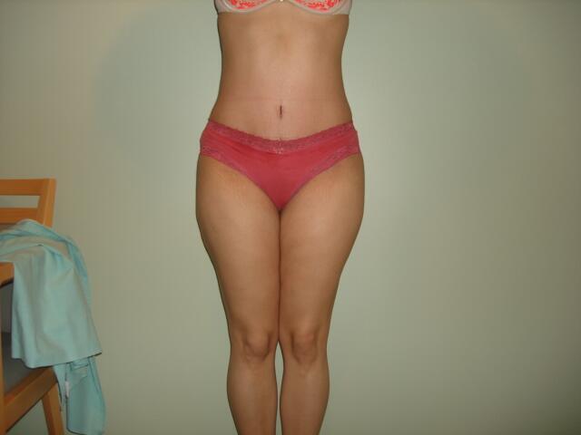 Tummy Tuck Before & After Image