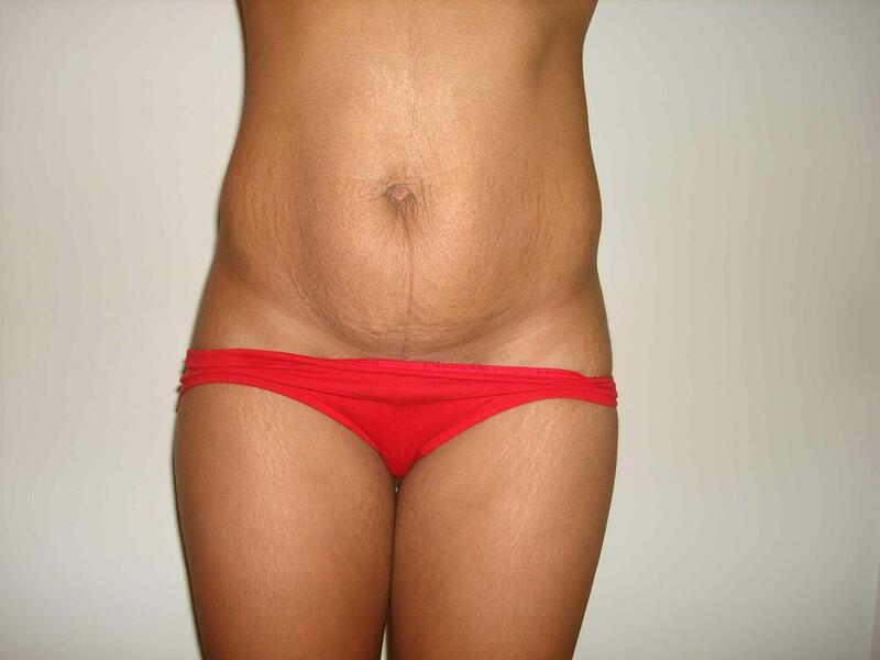 Tummy Tuck Before & After Image