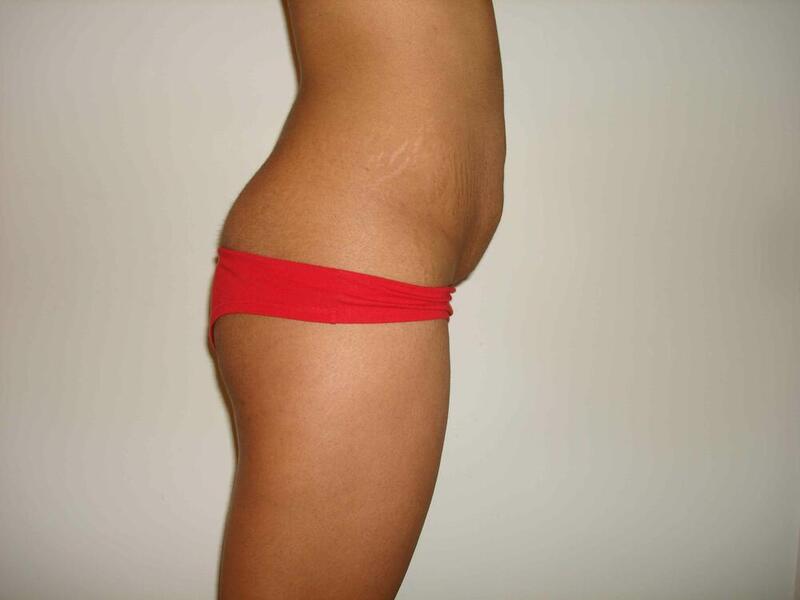 Tummy Tuck Before & After Image