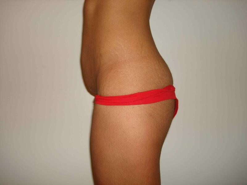 Tummy Tuck Before & After Image