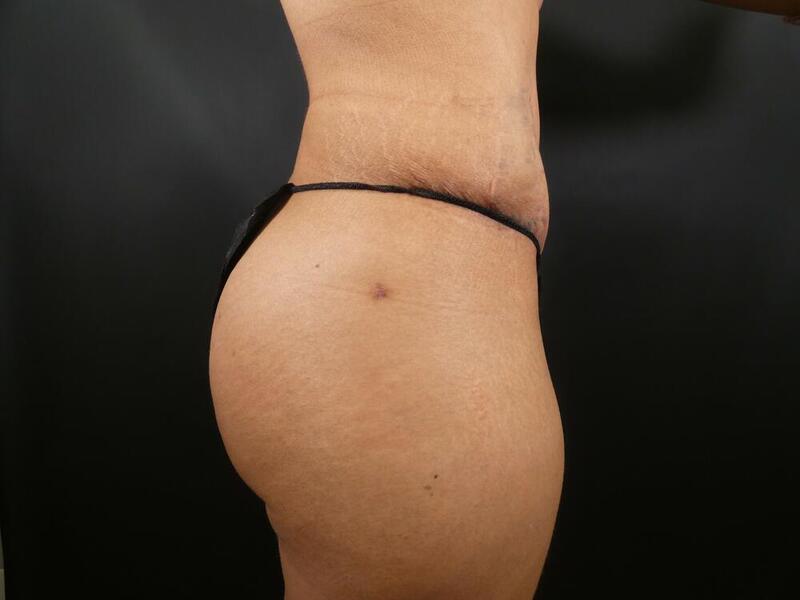 Tummy Tuck Before & After Image