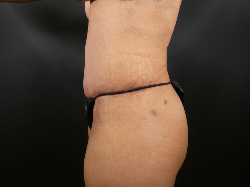 Tummy Tuck Before & After Image