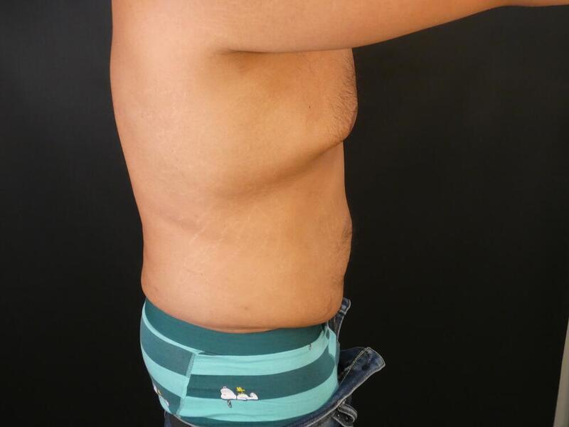 Tummy Tuck Before & After Image