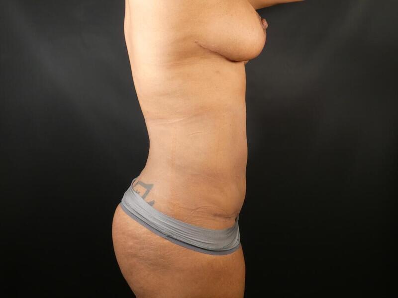 Tummy Tuck Before & After Image