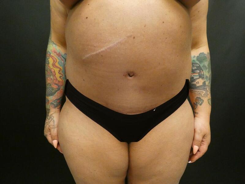 Tummy Tuck Before & After Image