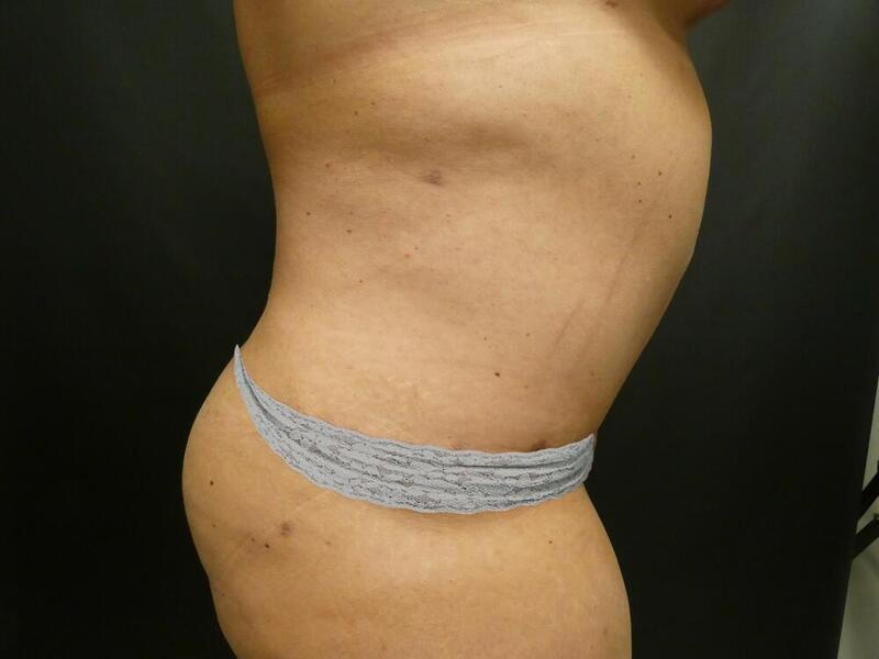 Tummy Tuck Before & After Image