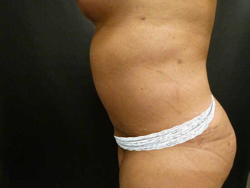 Tummy Tuck Before & After Image