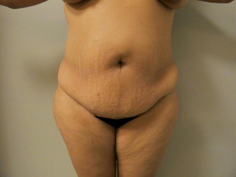 Tummy Tuck Before & After Image