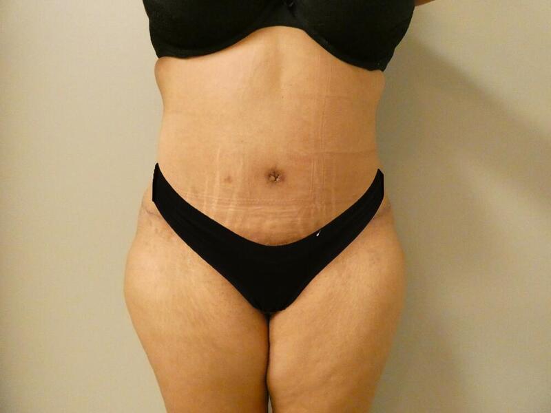 Tummy Tuck Before & After Image