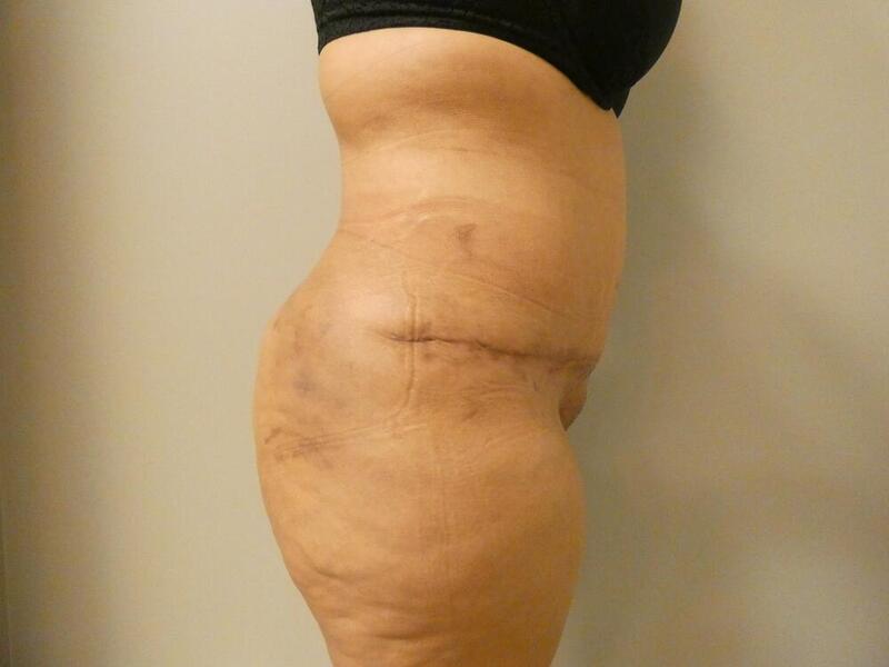 Tummy Tuck Before & After Image