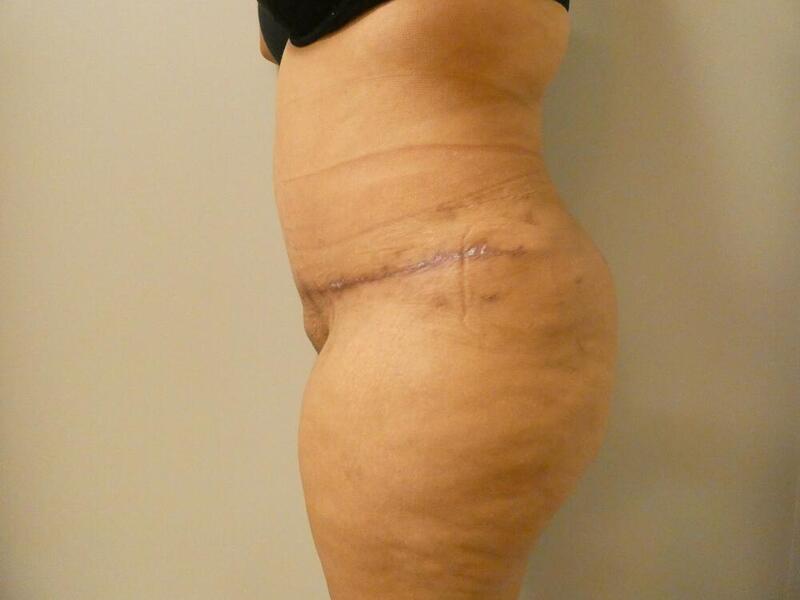 Tummy Tuck Before & After Image