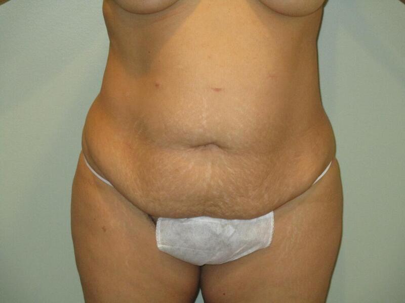 Tummy Tuck Before & After Image