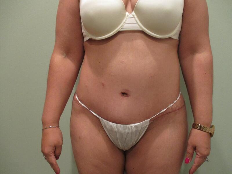 Tummy Tuck Before & After Image