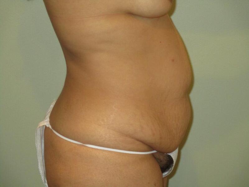 Tummy Tuck Before & After Image