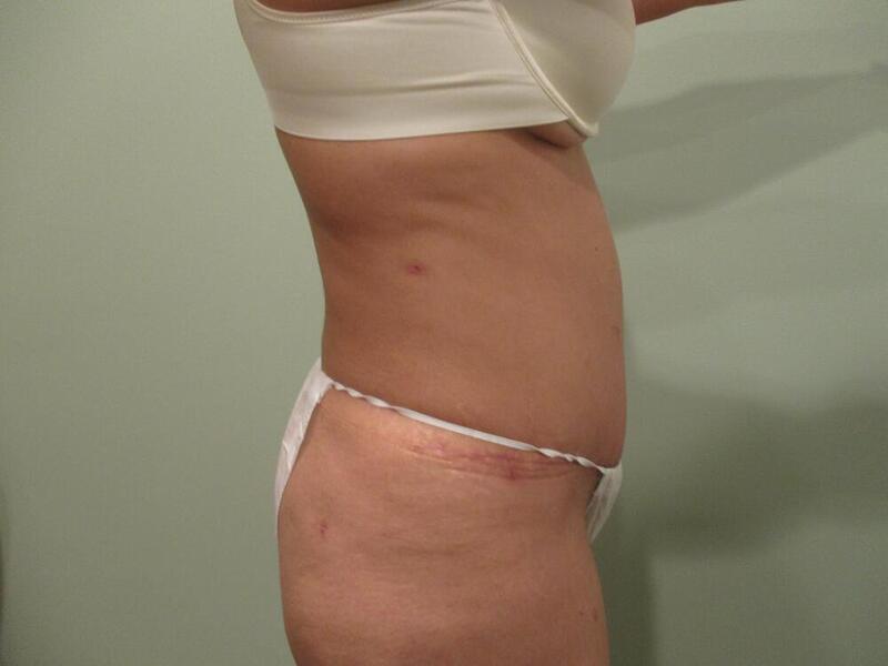 Tummy Tuck Before & After Image