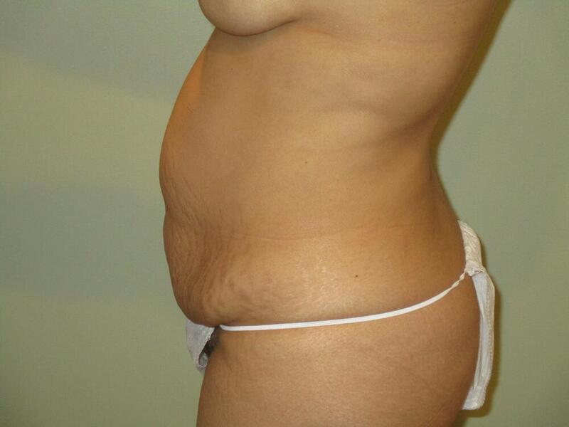 Tummy Tuck Before & After Image