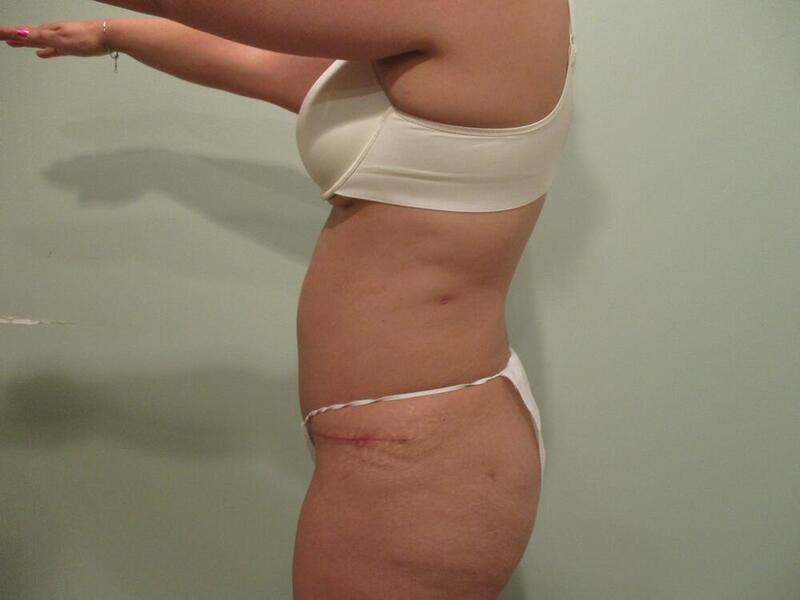 Tummy Tuck Before & After Image