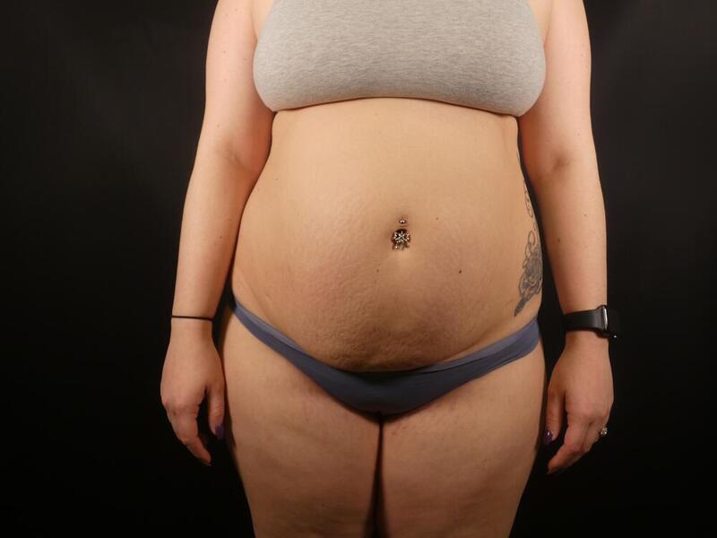 Tummy Tuck Before & After Image