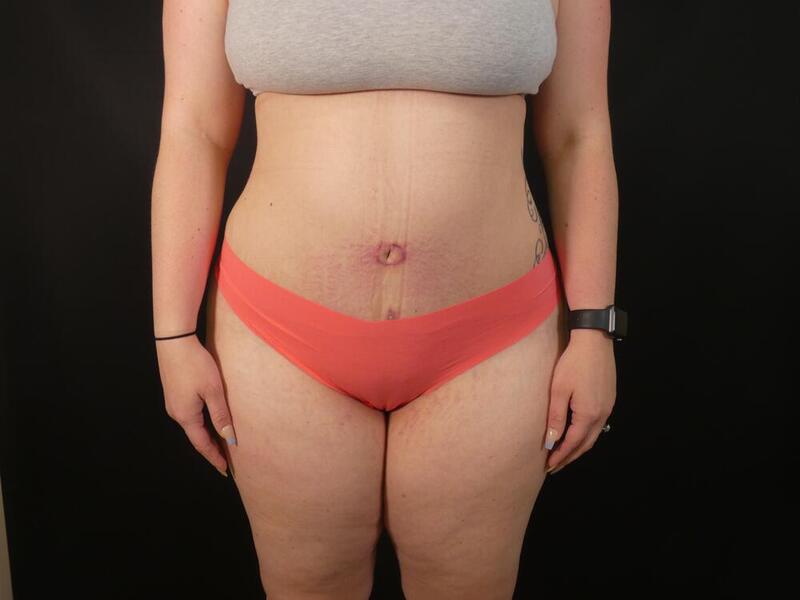 Tummy Tuck Before & After Image