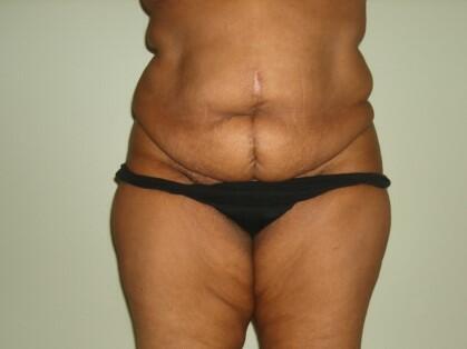 Tummy Tuck Before & After Image