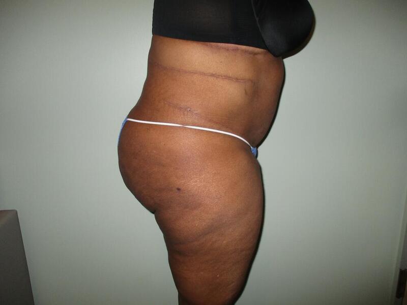 Tummy Tuck Before & After Image