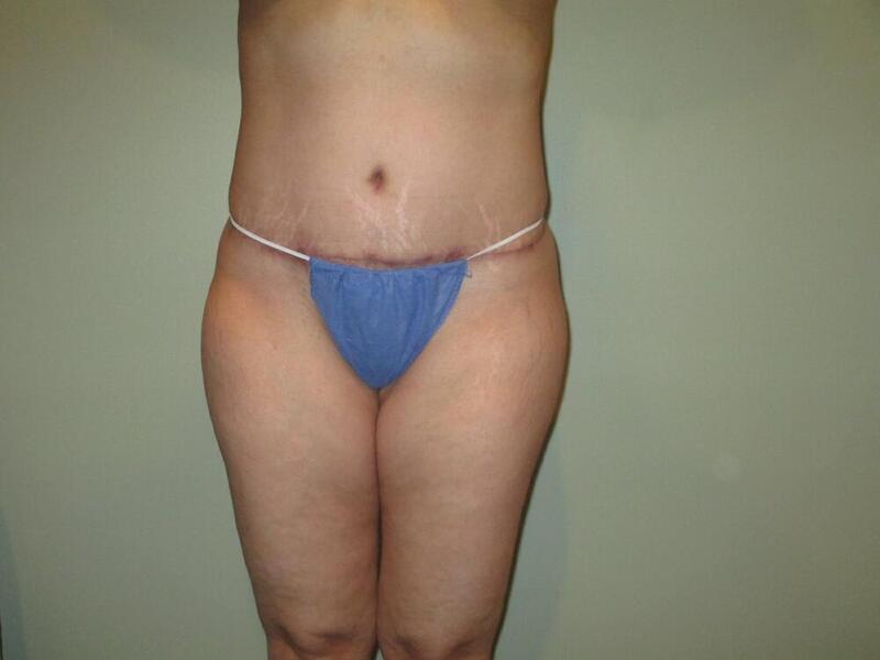 Tummy Tuck Before & After Image