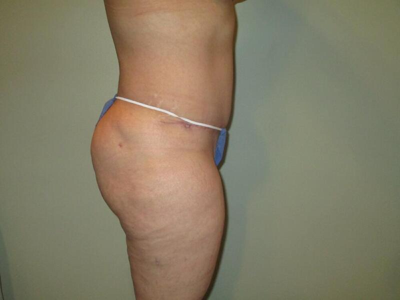 Tummy Tuck Before & After Image