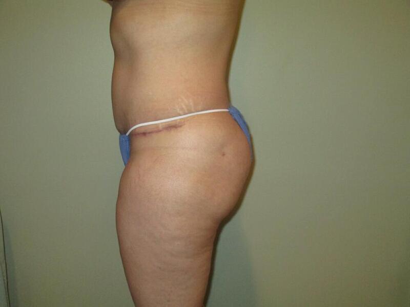 Tummy Tuck Before & After Image