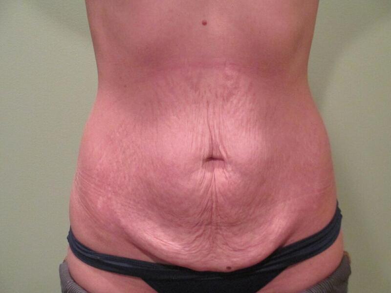 Tummy Tuck Before & After Image