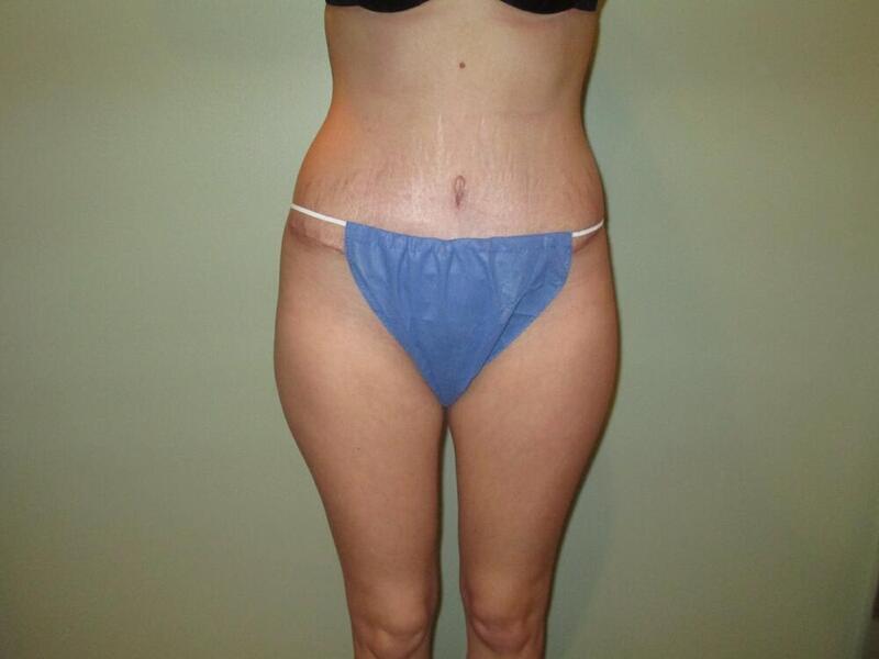 Tummy Tuck Before & After Image