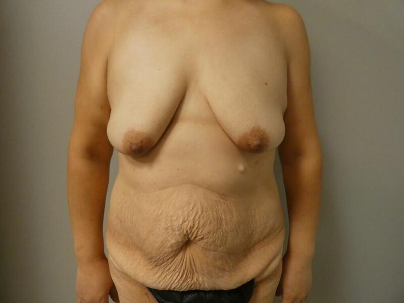 Tummy Tuck Before & After Image