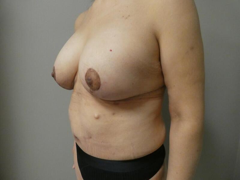 Tummy Tuck Before & After Image