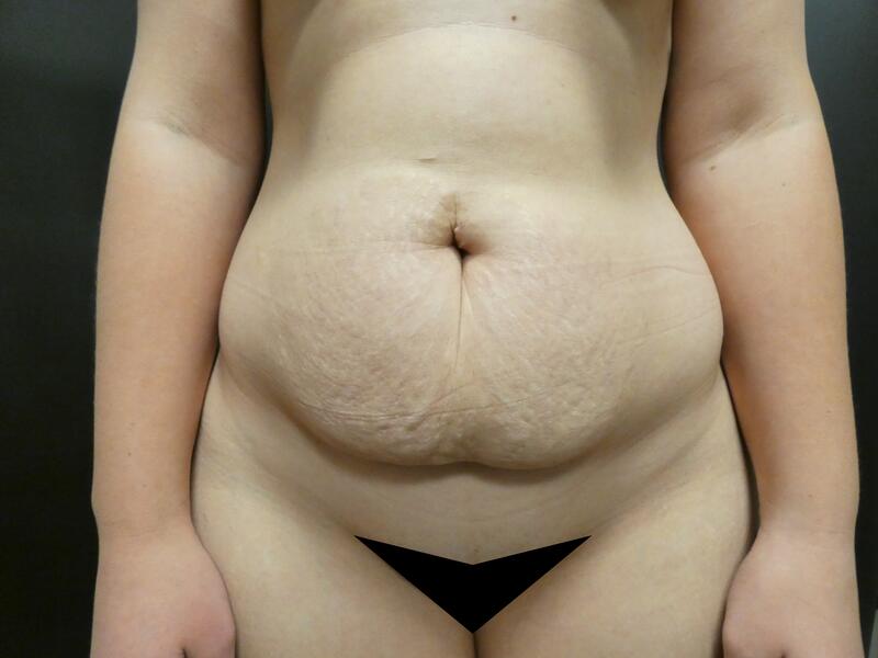 Tummy Tuck Before & After Image