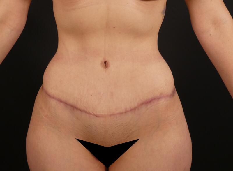 Tummy Tuck Before & After Image