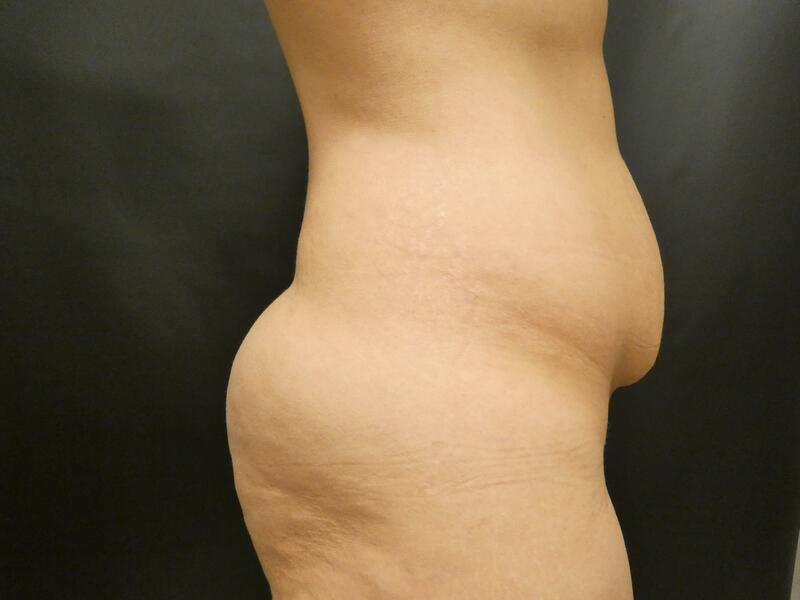 Tummy Tuck Before & After Image