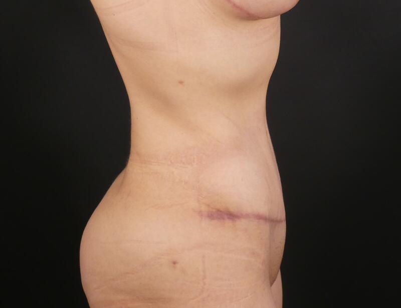 Tummy Tuck Before & After Image