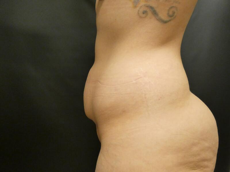 Tummy Tuck Before & After Image