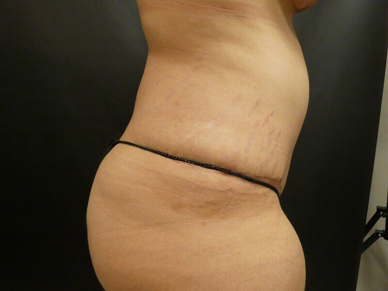 Tummy Tuck Before & After Image