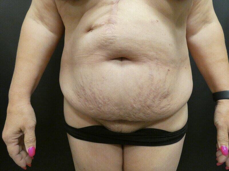 Tummy Tuck Before & After Image