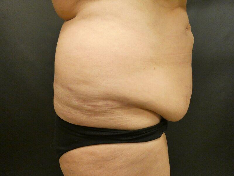 Tummy Tuck Before & After Image